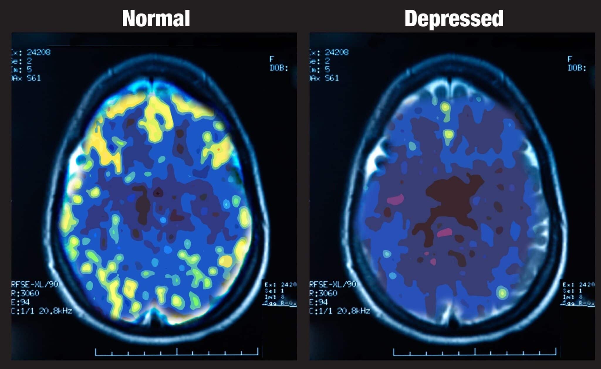 Una scansione PET misura funzioni vitali come il flusso sanguigno, l'uso di ossigeno e il metabolismo della glicemia (glucosio). Credits: Mark George, NIMH 1993