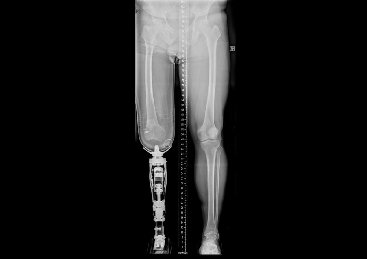 Protesi osteointegrate: quando l'arto artificiale è impiantato nell'osso - Protesi osteointegrate: quando l'arto artificiale è impiantato nell'osso. Credits: Case courtesy of Assoc Prof Frank Gaillard, Radiopaedia.org, rID: 32534