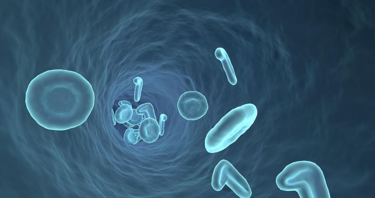 Aneurisma: un approccio per monitorarlo con l'intelligenza artificiale - 