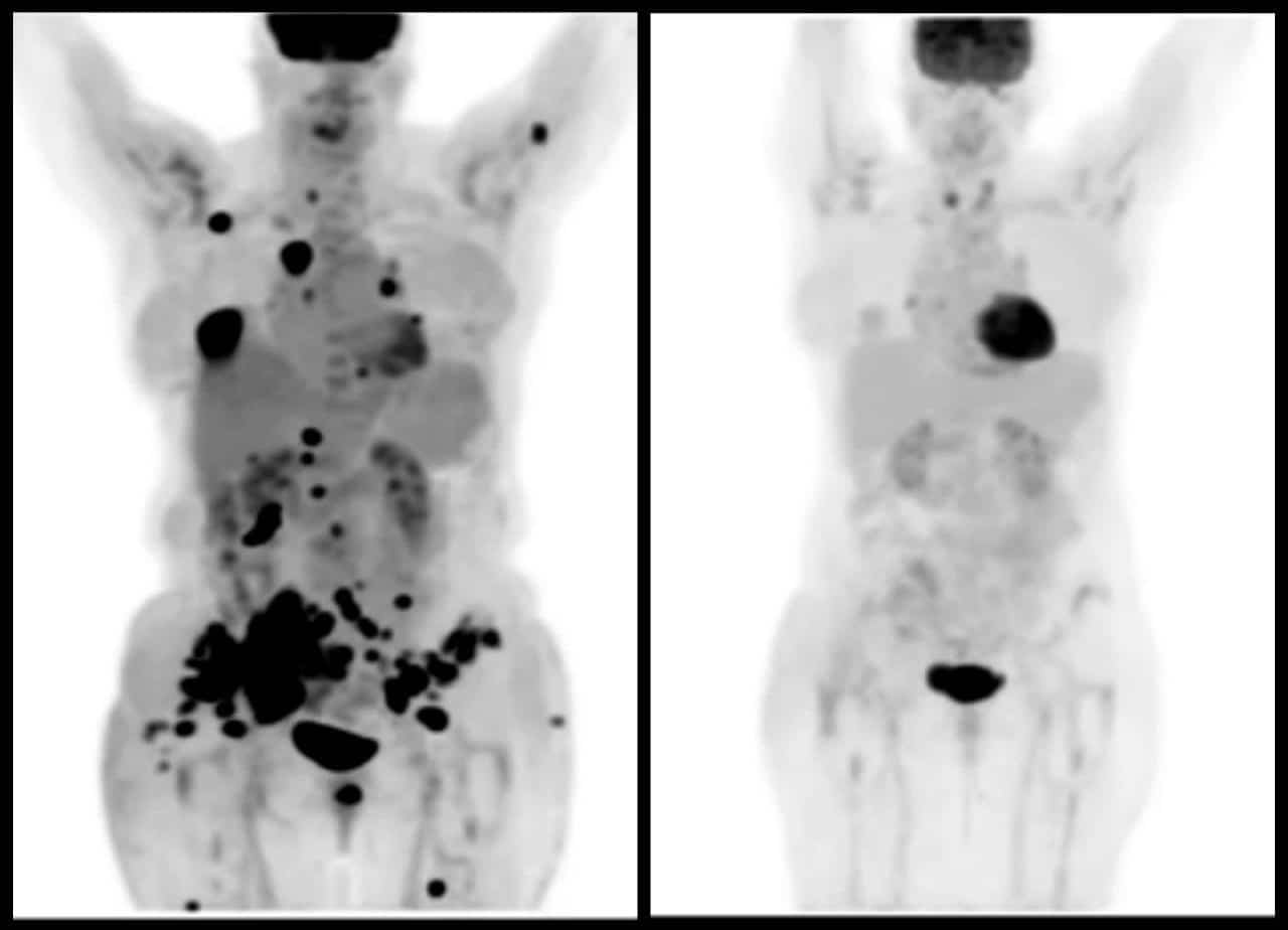 Remissione del tumore in seguito a immunoterapia - Credits: Il Dolomiti