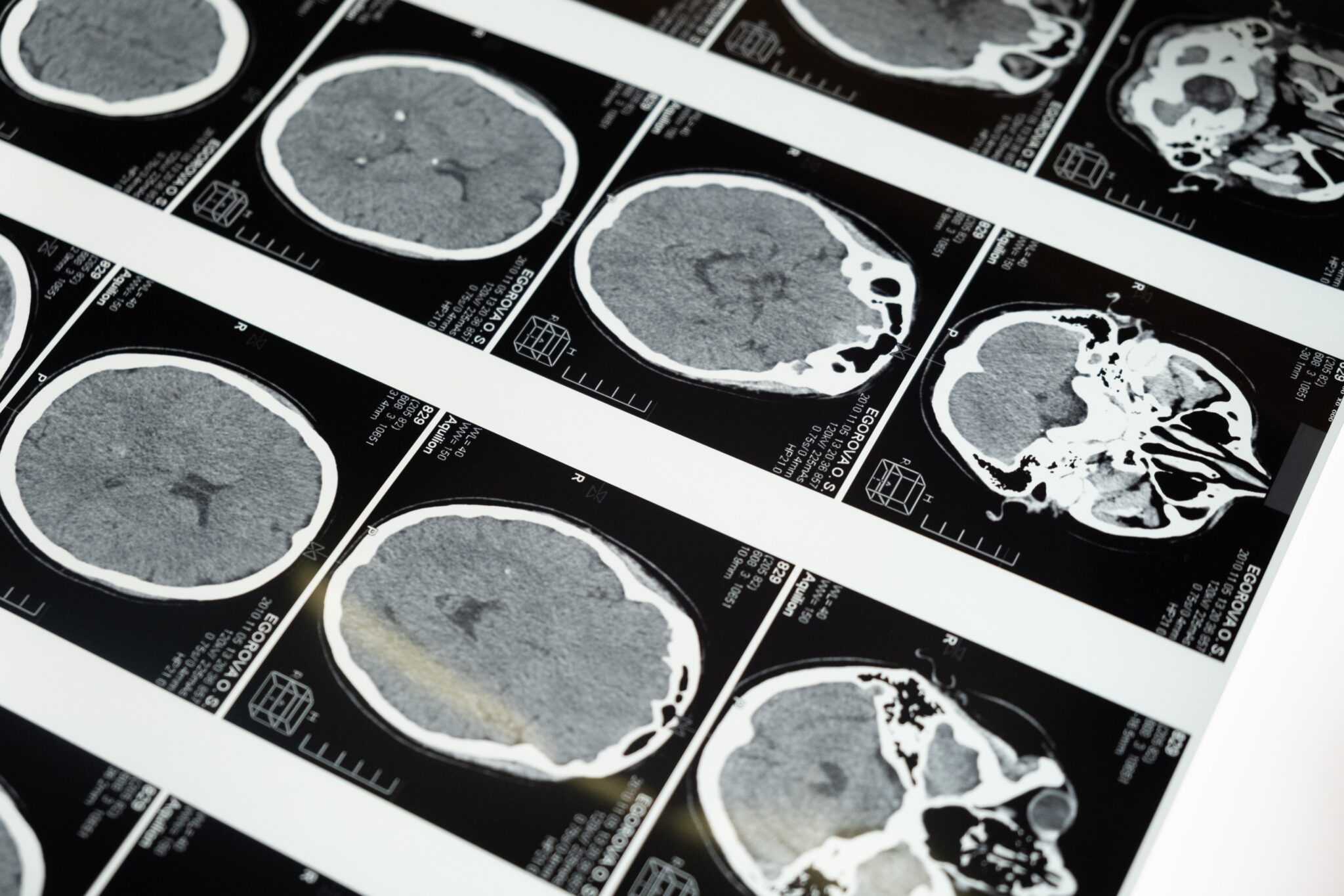 Il Neuroimaging è importante per la diagnosi dell’epilessia.