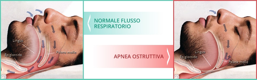 Immagine esplicativa dell'ostruzione delle vie aeree. Credits: apneasonnorussamento.it