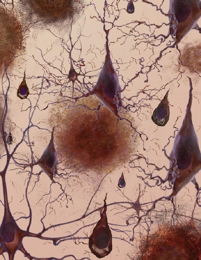 Cellule nervose affette da Alzheimer. Credits: EuroStemCell