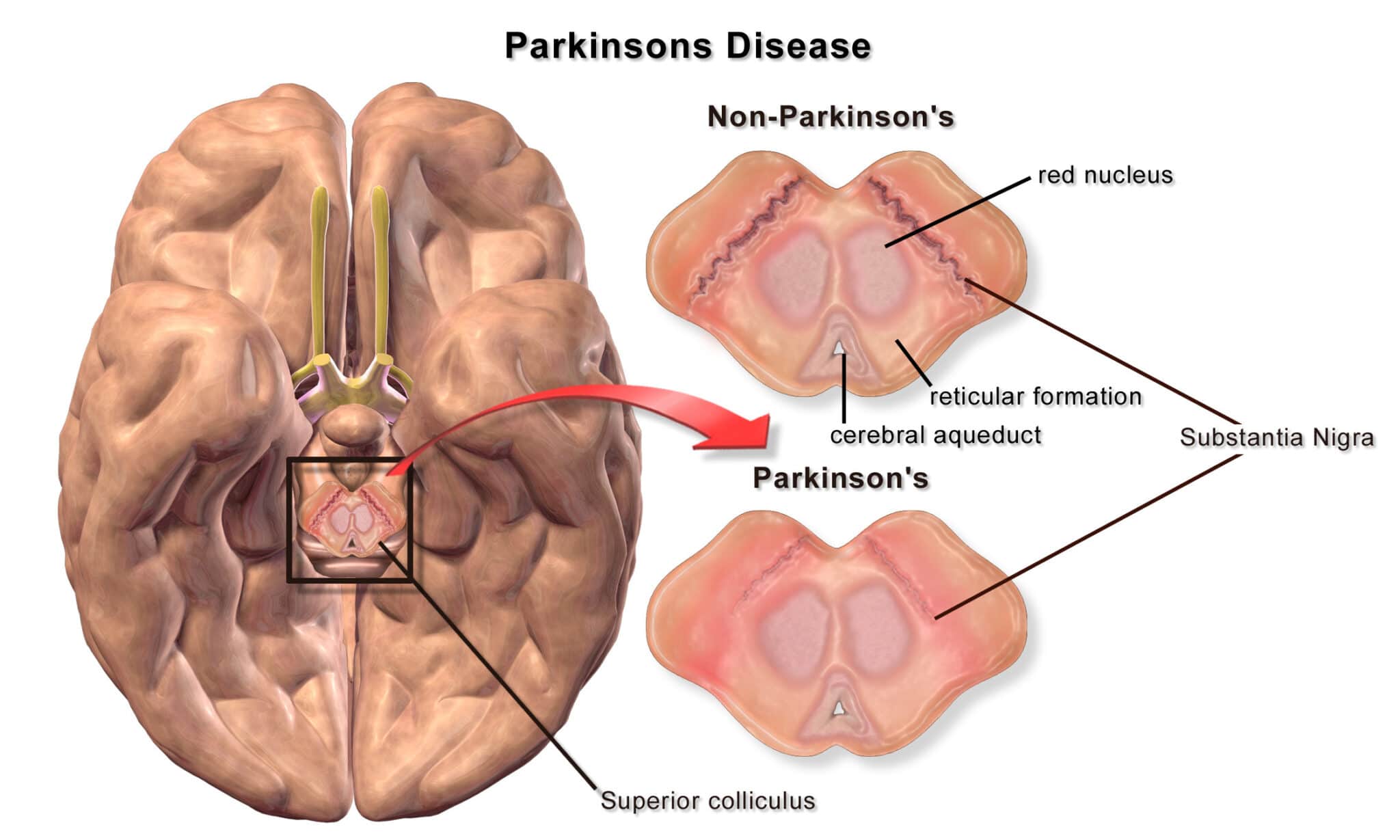 Degradazione della substantia nigra associata alla malattia di ParkinsonCredits:  Blausen.com staff (2014). "Medical gallery of Blausen Medical 2014". WikiJournal of Medicine 1 (2). DOI:10.15347/wjm/2014.010. ISSN 2002-4436.