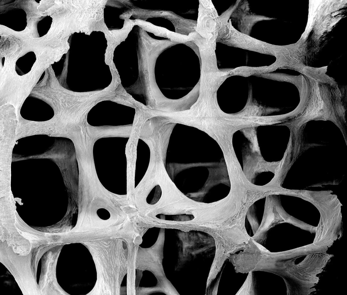 Biomimetica: nuovi materiali per pazienti colpiti da metastasi ossea - Credits: endocrinologiaoggi