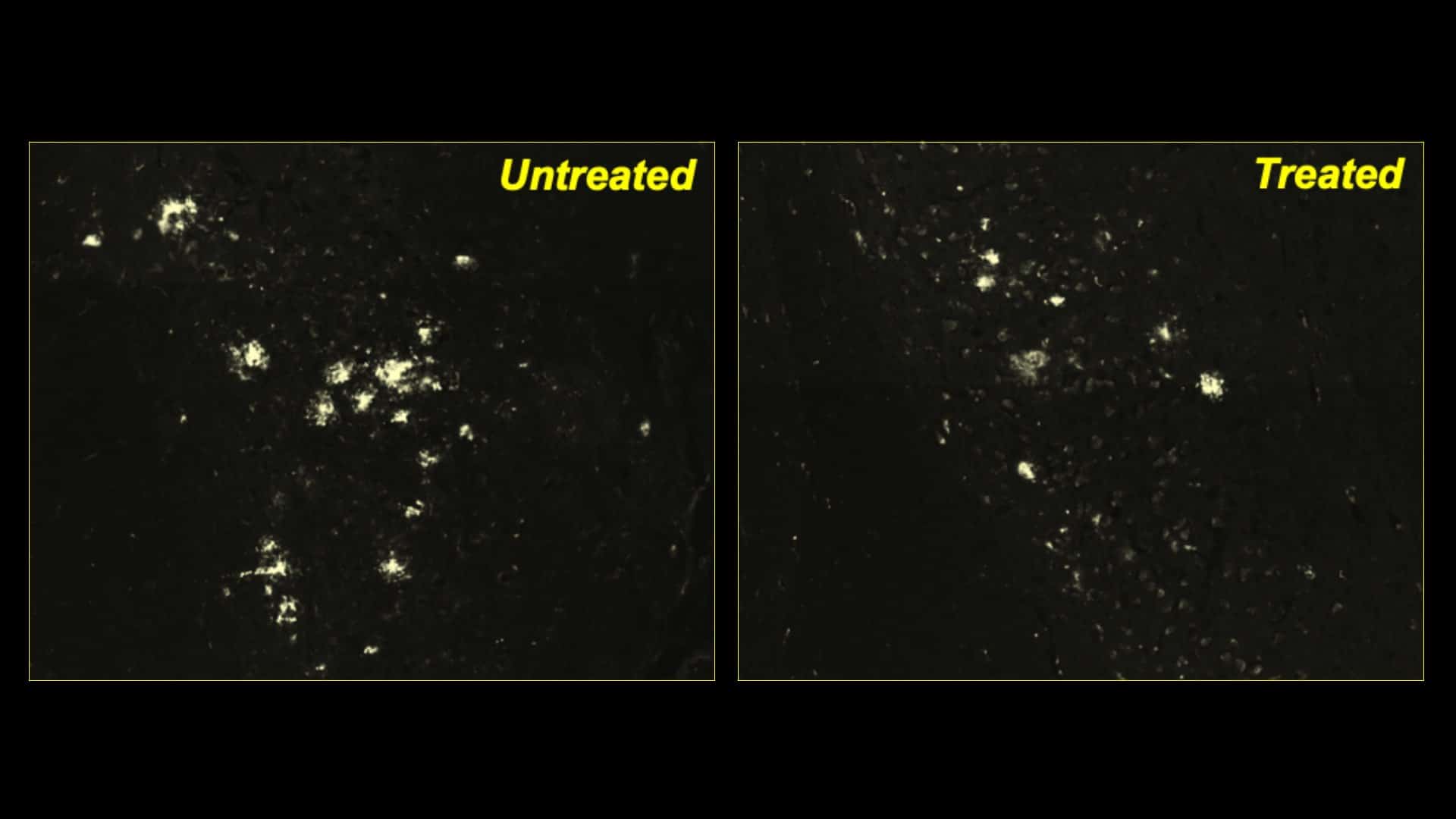 Confronto tra accumuli di proteine tossiche nei neuroni cerebrali tra topi in cui non è stato usato il farmaco e topi in cui è stato utilizzato. Credits: Albert Einstein College of Medicine.