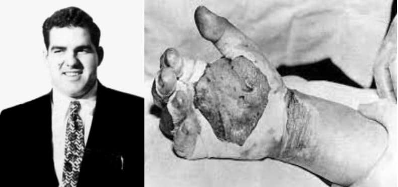 A sinistra Harry Daghlian; a destra e le ustioni riportate in seguito al contatto con il "fascio di luce blu".  Credits: Wikipedia