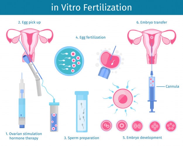 Fecondazione in vitro: FIVET