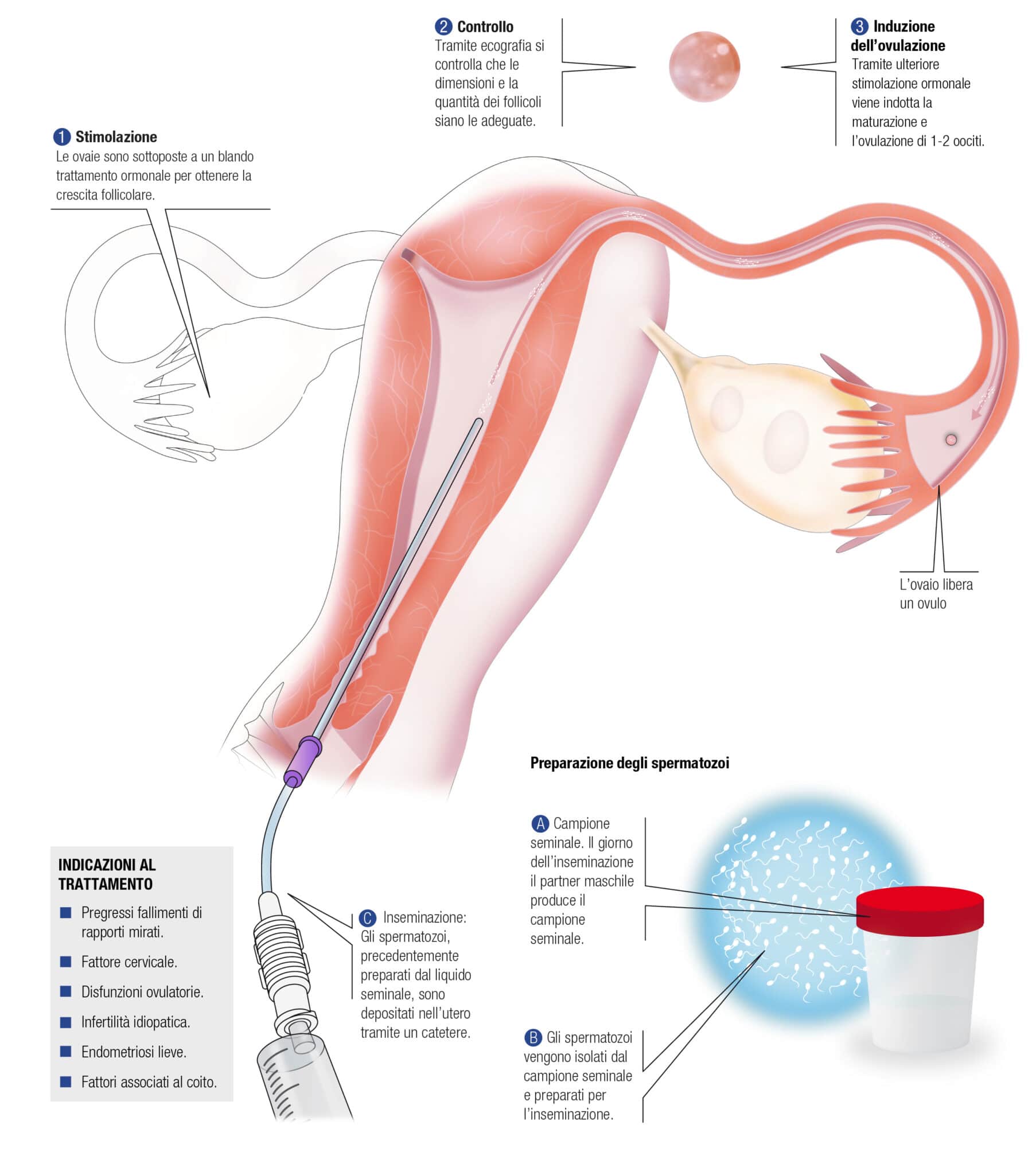 Schema sull'inseminazione artificale. Credits: Biogenesi