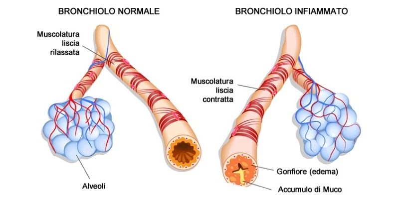 Differenza tra soggetto sano e soggetto asmaticoCredits: AbanoMed