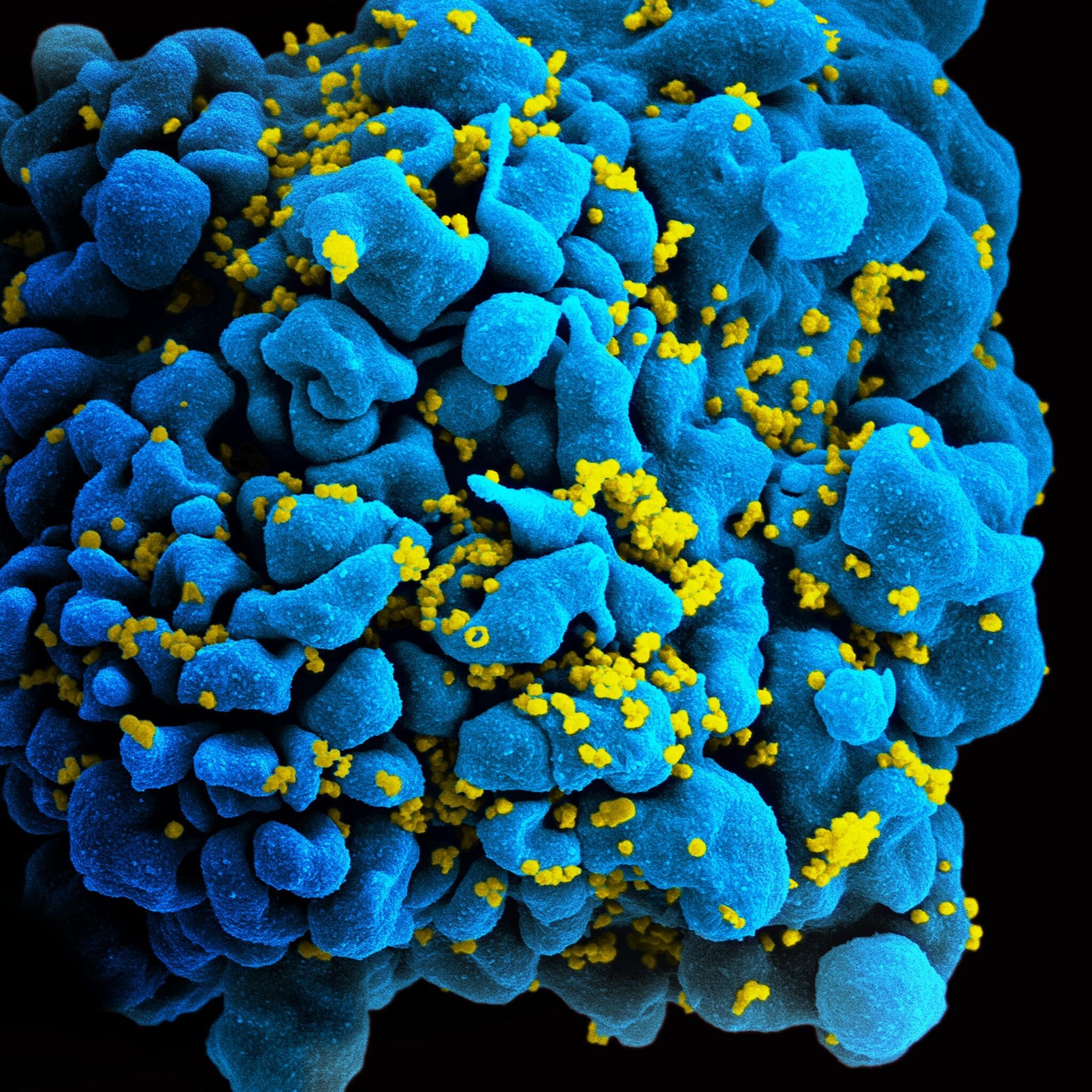 Micrografia elettronica a scansione di una cellula T infettata da HIV. Credits: NIAID