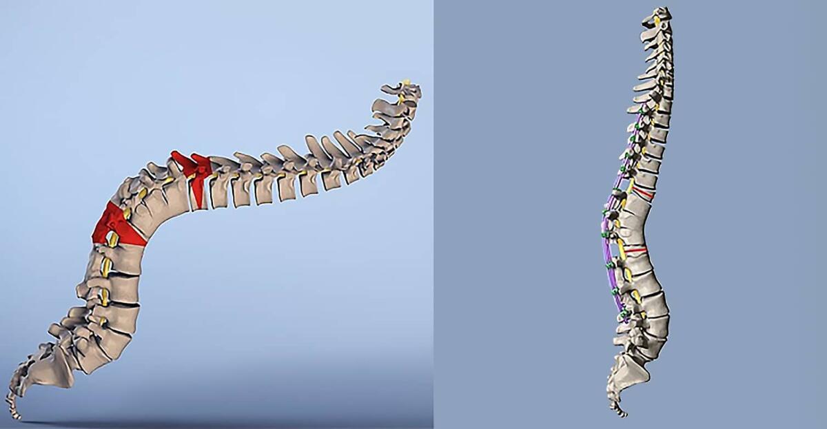 Corretta cifosi estrema rimuovendo due vertebre in un intervento innovativo - 