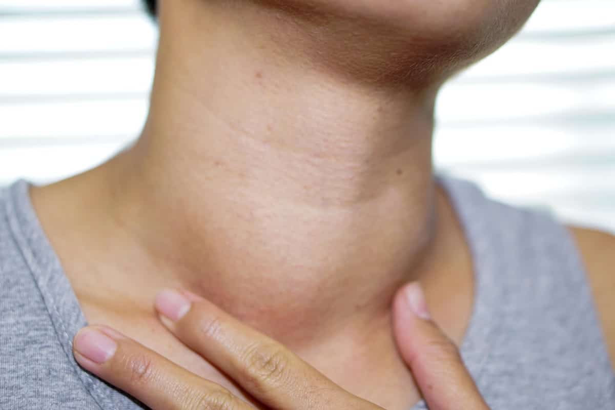 La paziente è una donna asiatica con un ingrossamento anomalo della ghiandola tiroidea dovuta ad ipertiroidismo. Credits: Getty
