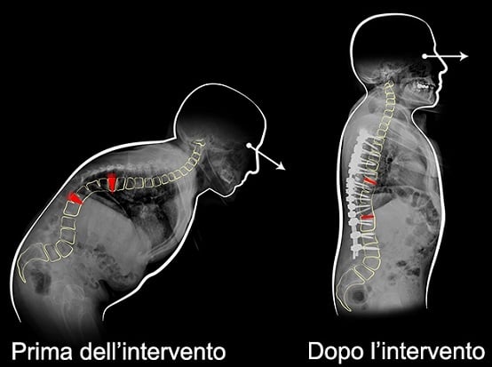 Prima e dopo l’intervento. Credits: Istuto Ortopedico Rizzoli