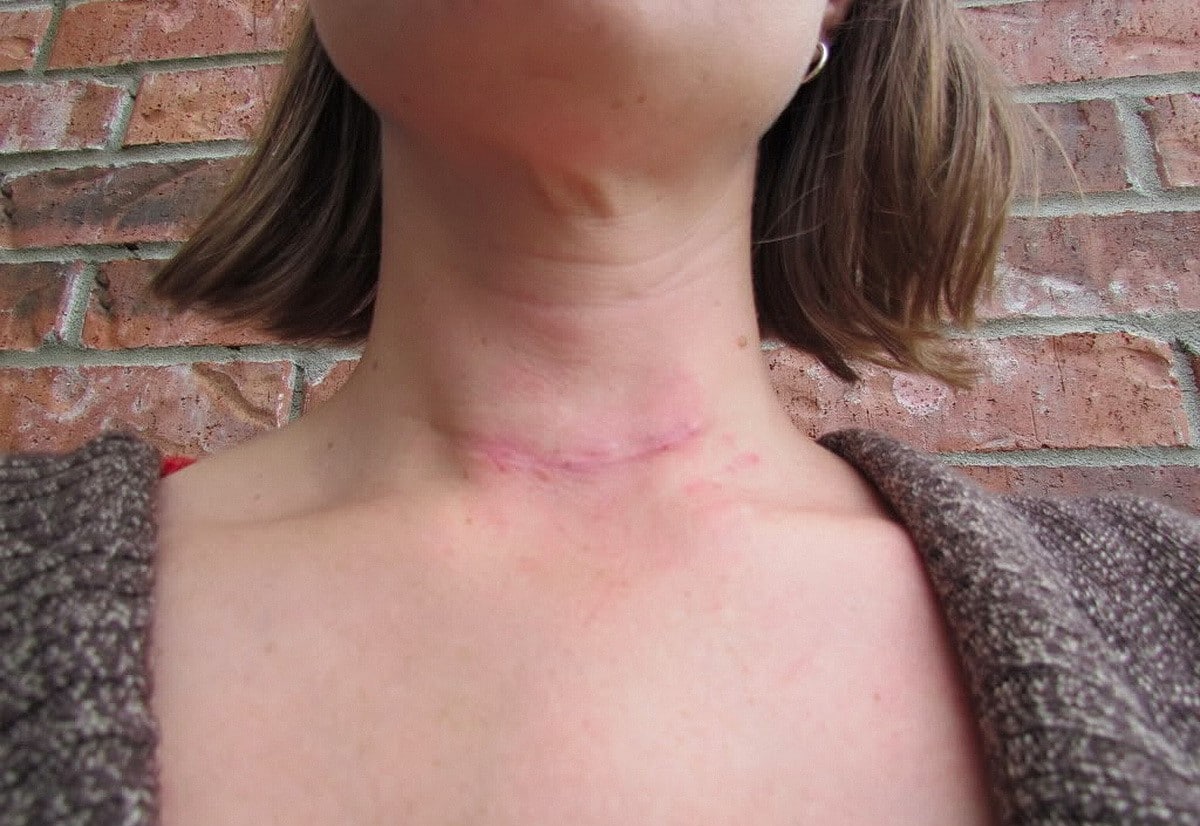 La tipica cicatrice di un intervento di tiroidectomia. Credits: Medicina Online