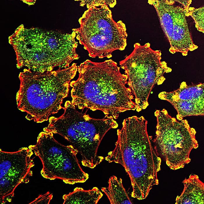 Cellule di melanoma. Credits: Julio C. Valencia
