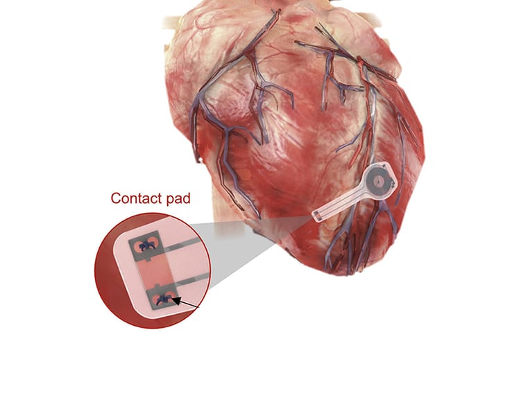 Gli elettrodi vengono posti sulla superficie del cuore e vengono attivati da remoto. Credits: Medgadget