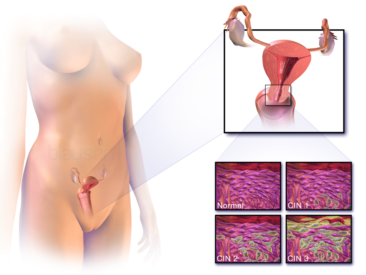 Ubicazione della cervice ed esempi di epitelio cervicale normale e anormale.Credits: Wikipedia