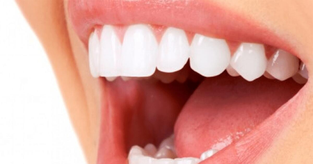 Osteoporosi e impianti dentali - 