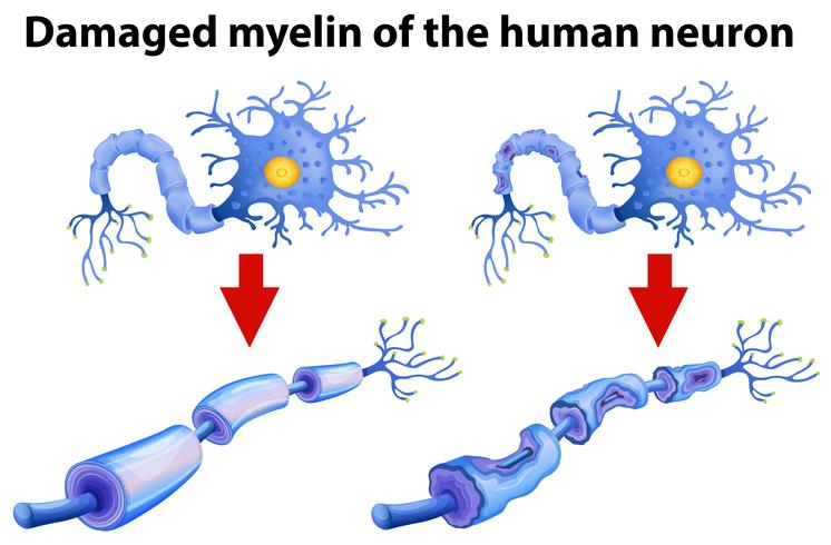 A sinistra si osservano neuroni avvolti da mielina correttamente. A destra si osservano neuroni avvolti da mielina danneggiata. Dormire rigenera la mielina. Credits: The Journal of Neuroscience.