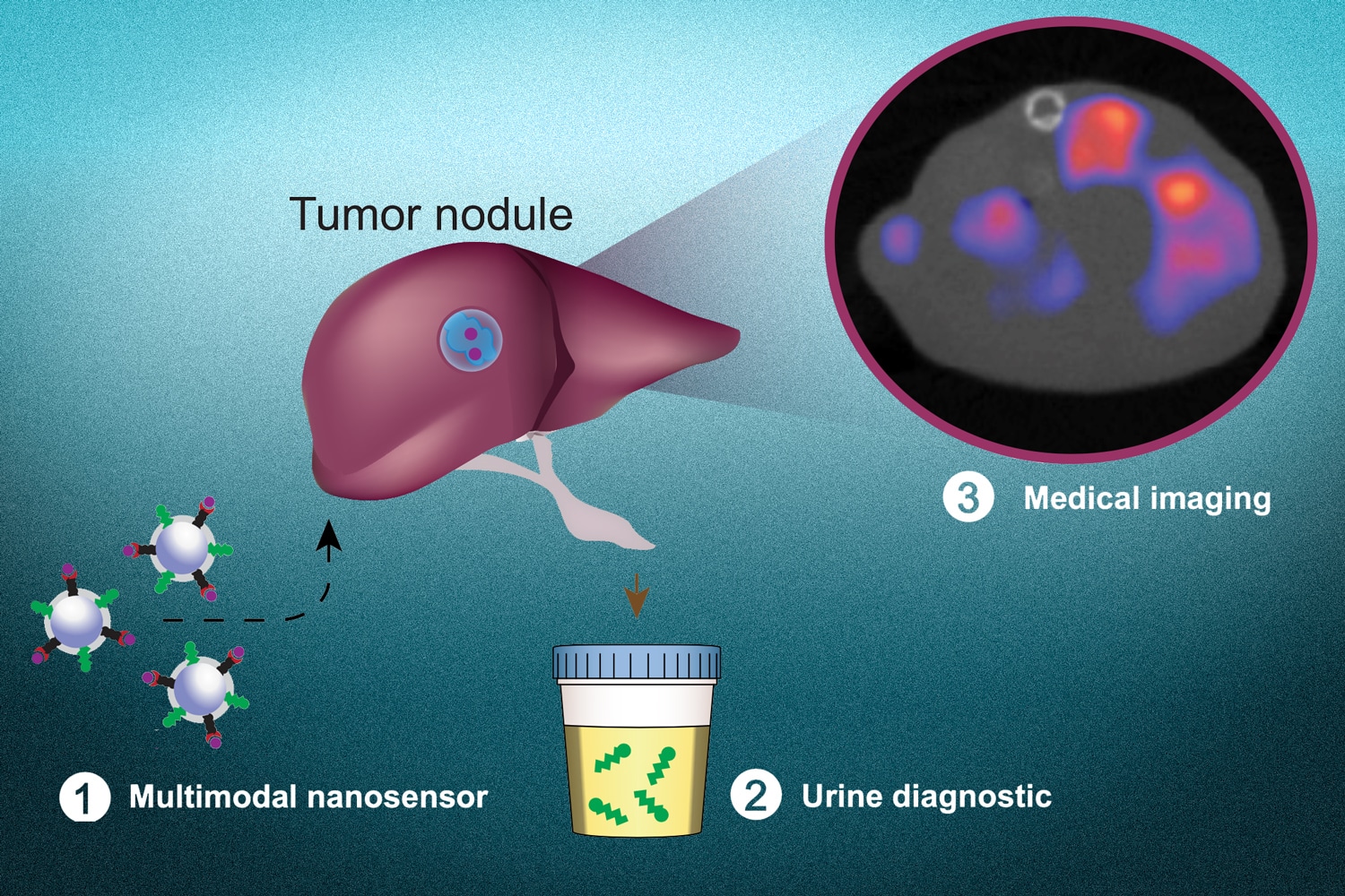 I nanosensori multimodali (1) sono progettati per rispondere ai segni distintivi del microambiente tumorale. I nanosensori forniscono sia uno strumento di monitoraggio urinario non invasivo (2) sia un agente di imaging medico (3) per localizzare le metast