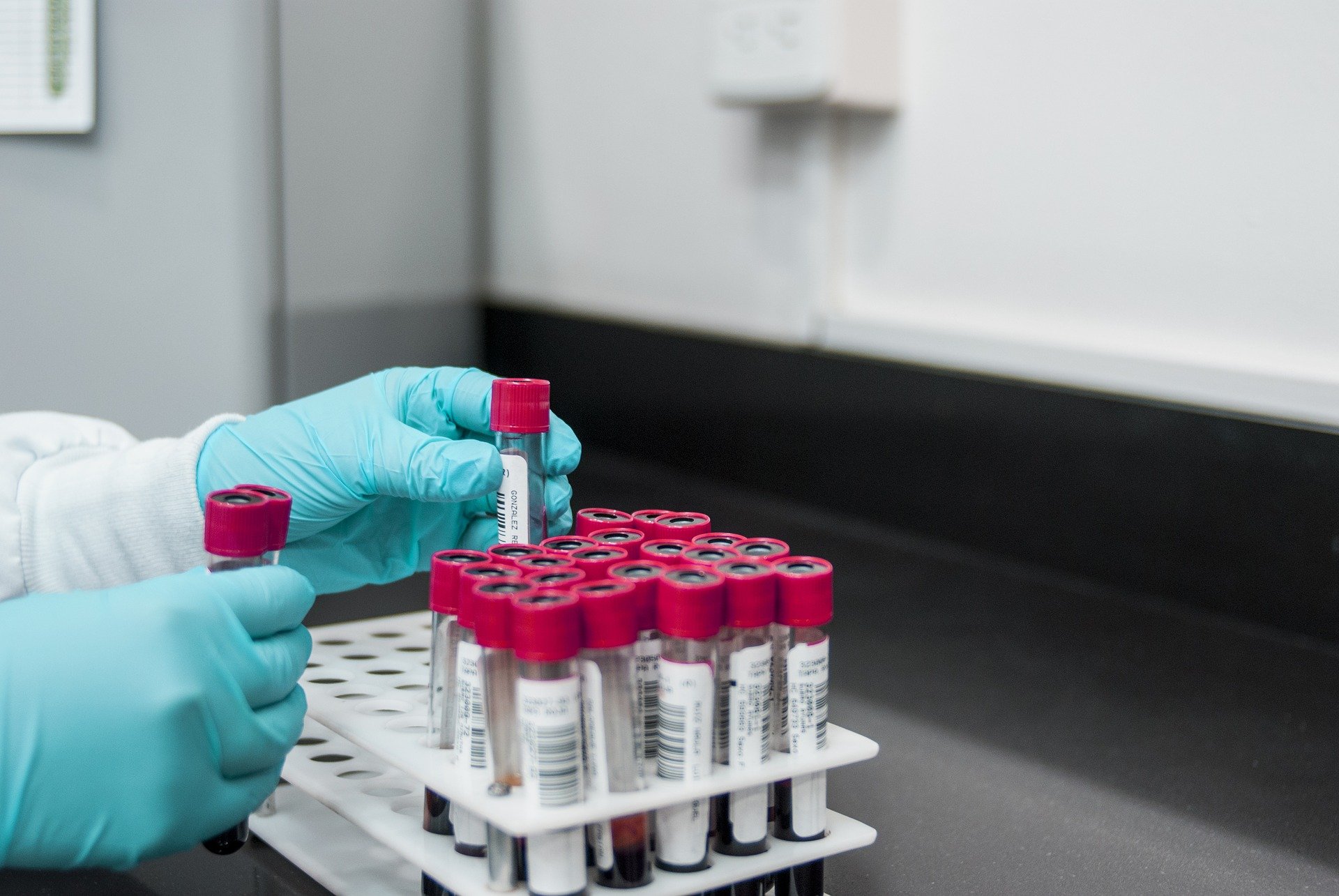 Esame del sangue per diagnosticare l'Alzheimer