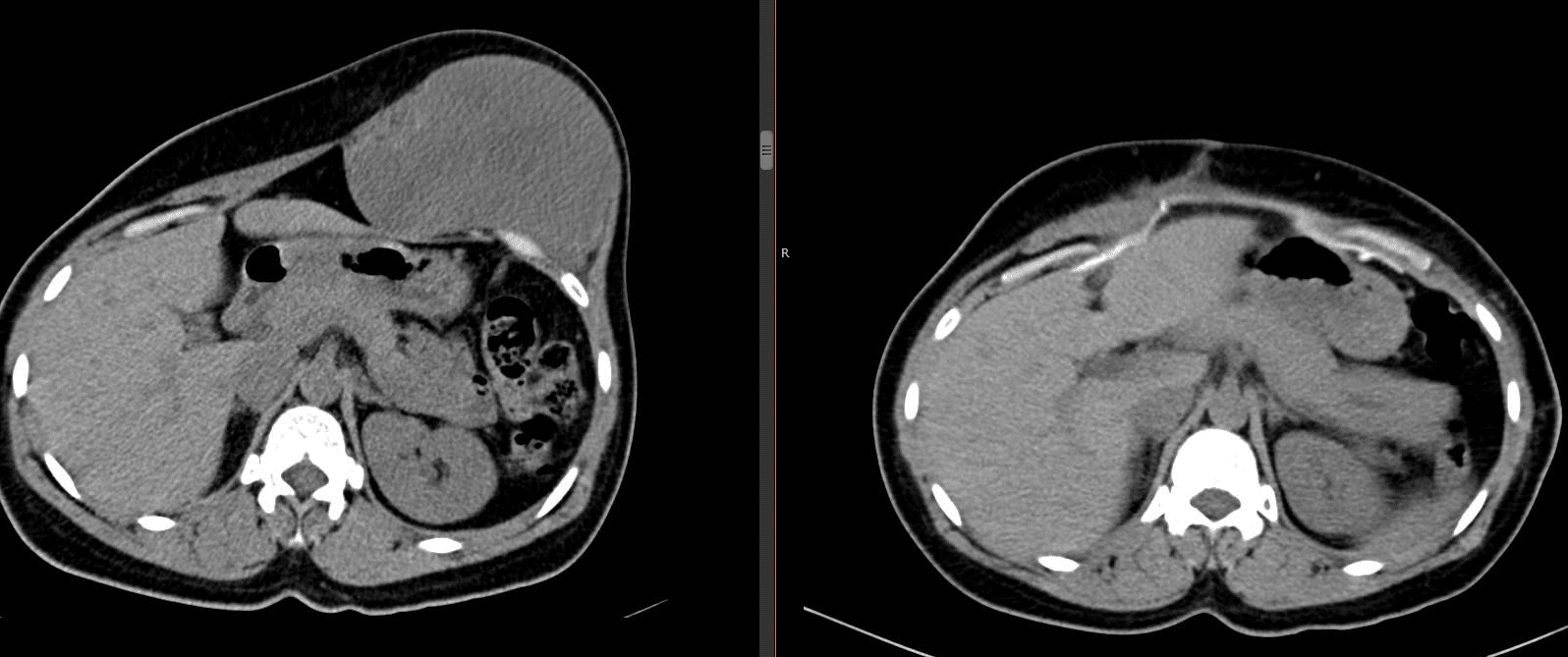 Fibromatosi desmoide - Confronto tra Risonanze magnetiche: progressione spontanea, età: 35 anni - Credits: Desmoid Foundation