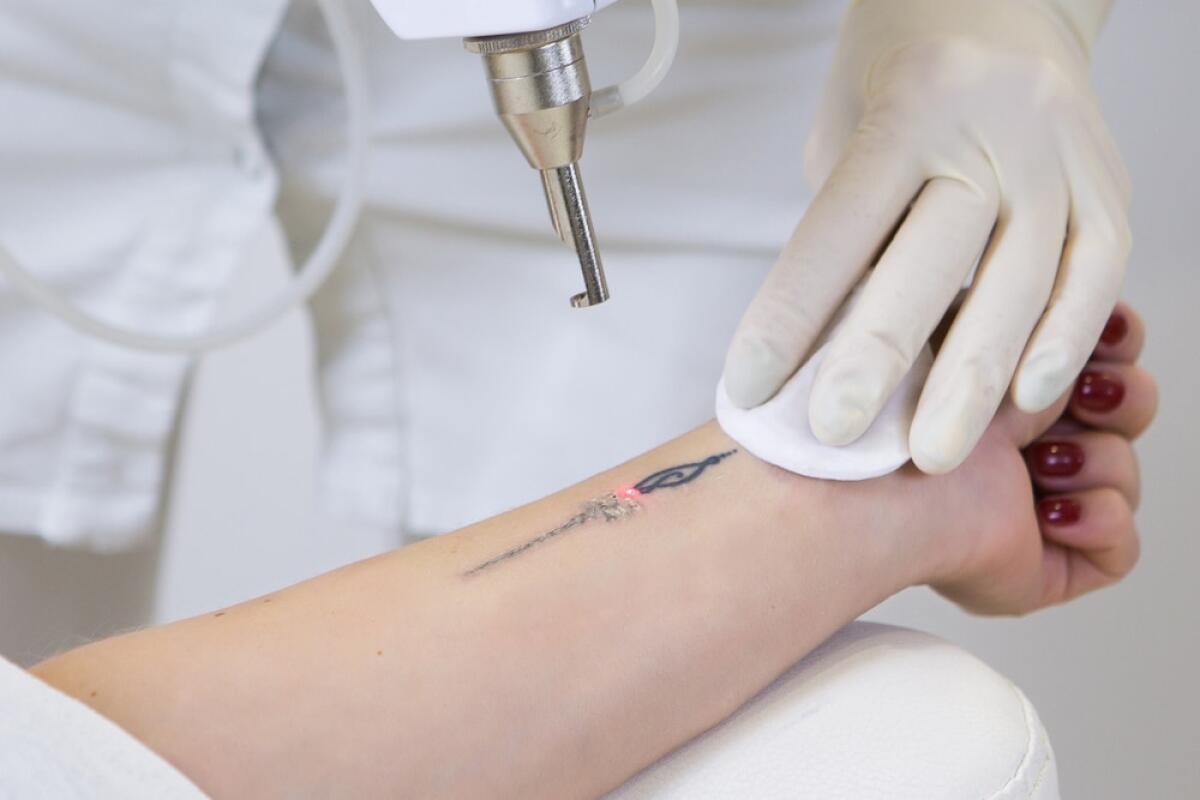 Rimuovere i tatuaggi: un’opportunità concreta al giorno d’oggi - 