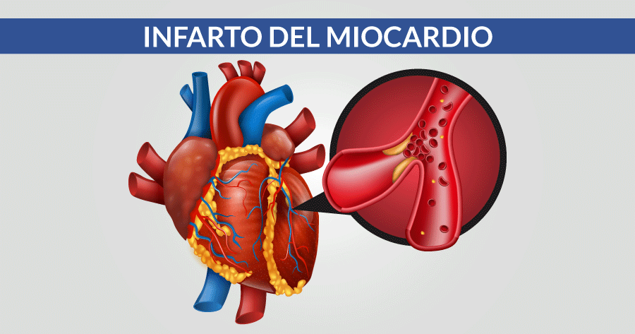Infarto del miocardio. Credits: Cardio Center Napoli