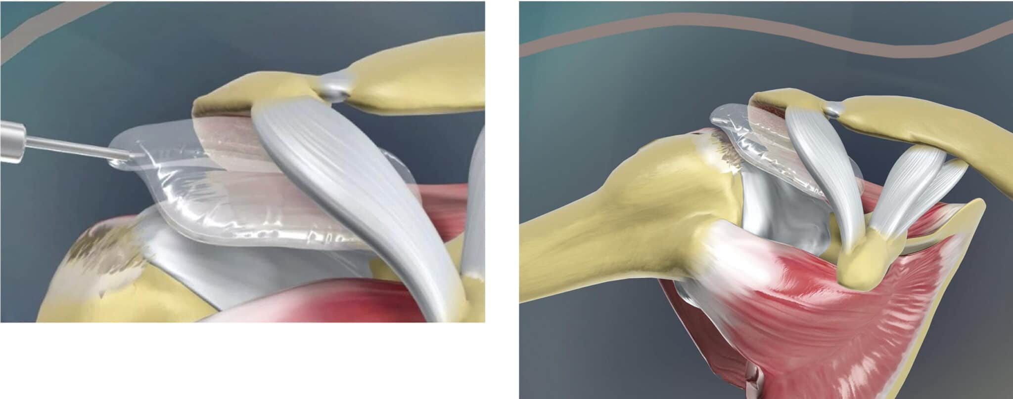 Credits: Savarese, E., & Romeo, R. (2012). New solution for massive, irreparable rotator cuff tears: the subacromial “biodegradable spacer”. Arthroscopy techniques, 1(1), e69-e74.