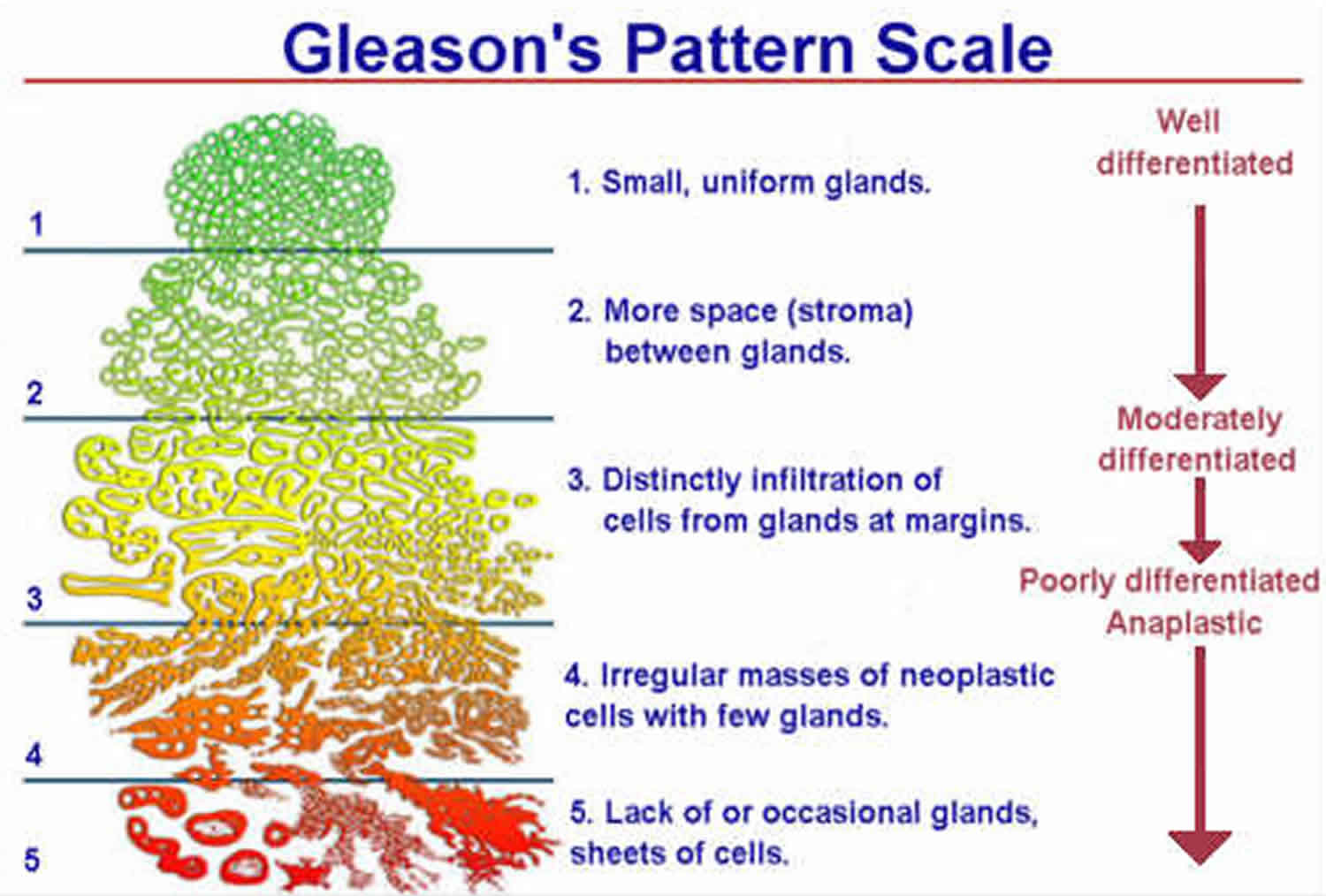 La scala di Gleason aiuta la prognosi di pazienti con cancro prostatico. Crediti: healthjade.net