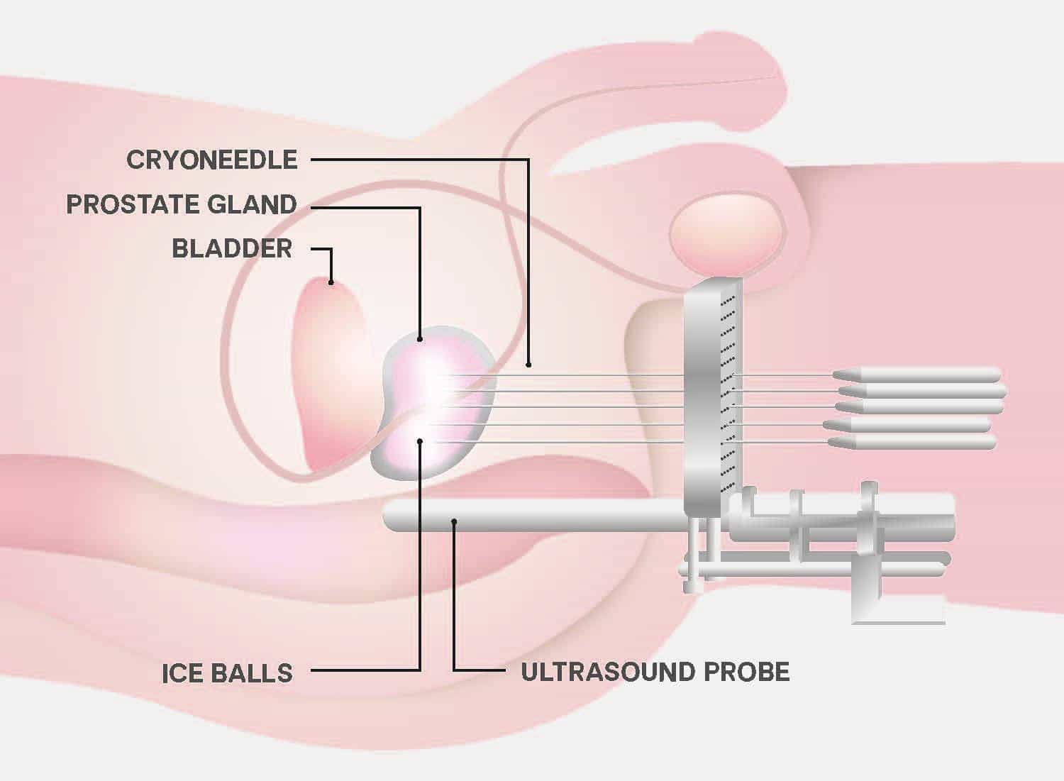 Credits: Weill Cornell Medicine Urology