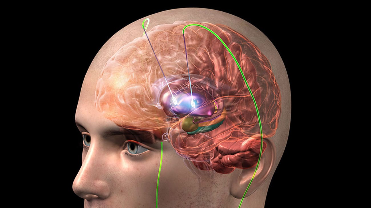 Uno schema elementare del funzionamento della DBS. Credit: Cleveland Clinic