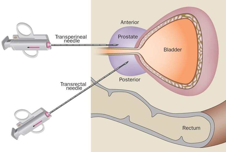La biopsia della prostata aiuta la diagnosi. Crediti: chuikalunurology.medium.com