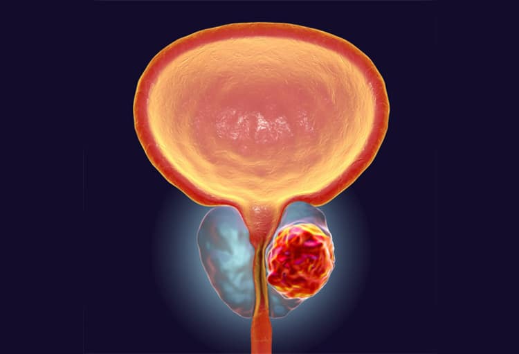 Rappresentazione di un tumore alla prostata che comprime l'uretra. Crediti: debuglies.com