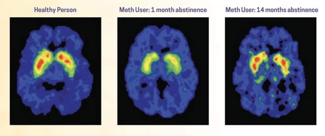 In rosso e verde sono evidenziati i legami tra la dopamina e i trasportatori DAT nella regione dello striato. Credits: National Institute on Drug Abuse - What are the long-term effects of methamphetamine misuse?