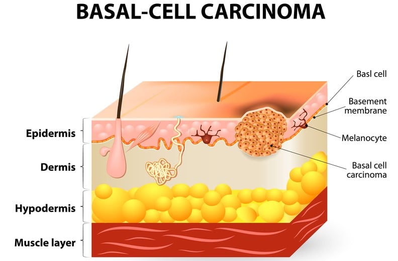 Visualizzazione del basalioma a livello della pelle. Crediti: universityhealthnews.com