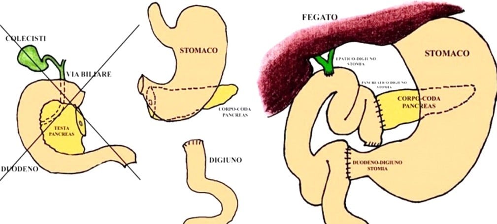 Schema dei tagli e ricostruzioni nella DCP. Crediti: medicinaonline.it