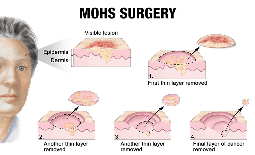 Chirurgia di Mohs: una delle tecniche principali di rimozione del basalioma. Crediti: healthjade.com