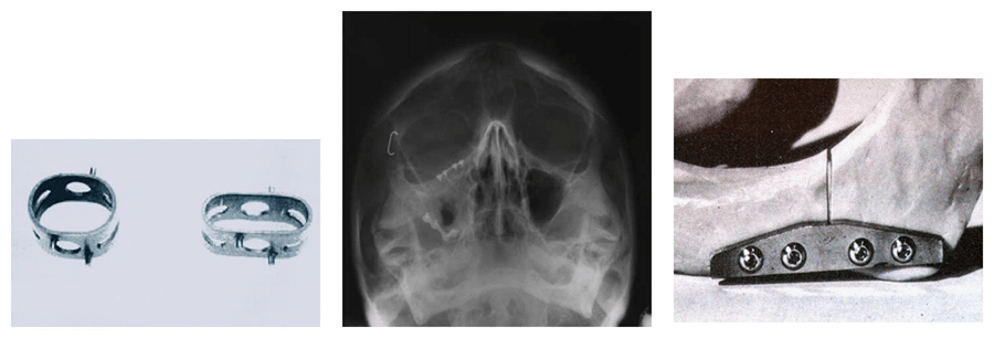 Fonte immagine: Lorenza Petrini, Francesco Migliavacca, "Biomedical Applications of Shape Memory Alloys", Journal of Metallurgy, vol. 2011, Article ID 501483, 15 pages, 2011.