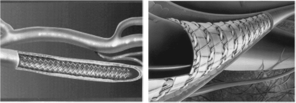 Fonte immagine: T. Duerig, A. Pelton, D. Stockel, “An overview of nitinol medical applications”, Materials Science and Engineering A273–275 (1999) 149–160.