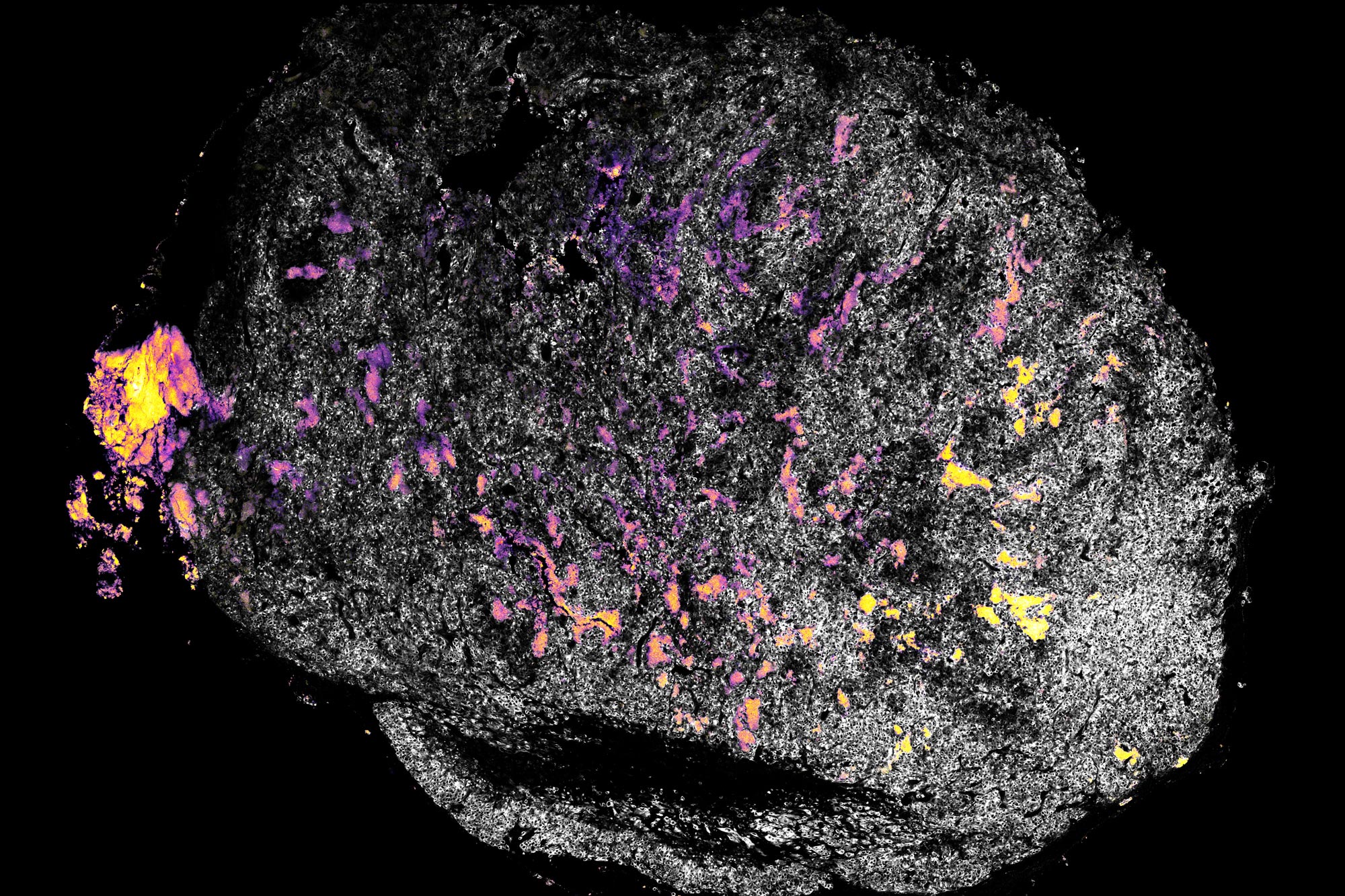 Il tumore in seguito al trattamento con idrossido di alluminio (in giallo) e IL-12 (in rosa). Credit: ricercatori MIT