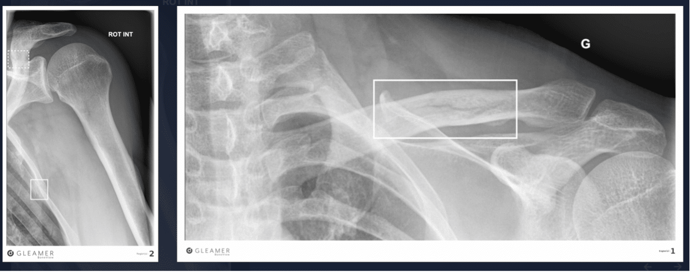 Risultati su radiografia di un uomo di 41 anni in seguito a incidente in moto. BoneView ha rilevato una frattura alla clavicola e una a una costola. Entrambe erano di difficile individuazione. Credits: gleamer.ai
