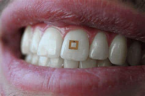 Il sensore miniaturizzato aderisce alla superficie del dente.