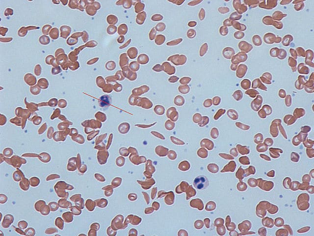 Anemia falciforme: scoperta una possibile una cura?  
