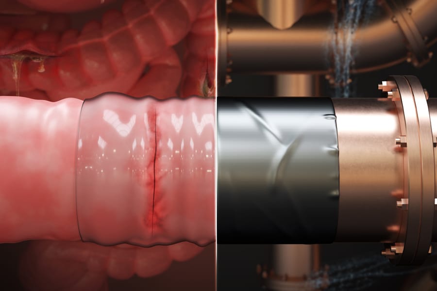Paragone tra il cerotto gastrointestinale e il nastro adesivo per riparare i tubi. Credits: MIT