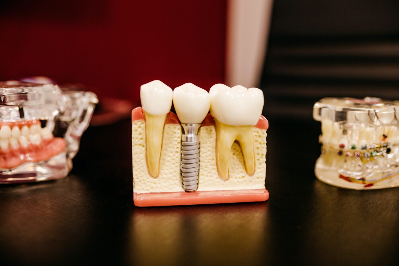 Implantologia dentale