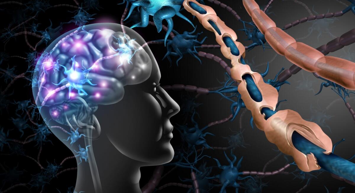 I latticini potrebbero aggravare i sintomi della Sclerosi Multipla - Sclerosi multipla: sviluppata un'app per aiutare il trattamento dei pazienti.