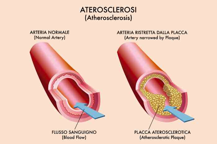 Aterosclerosi e infarto