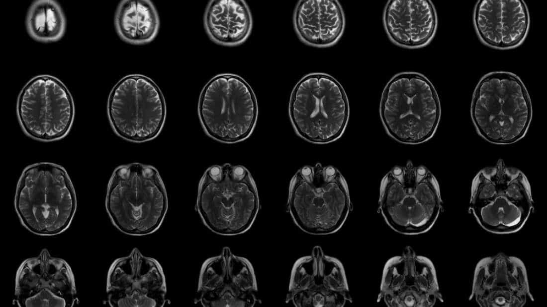 Scansioni MRI per visualizzare le alterazioni sul cervello. Crediti: iflscience.com